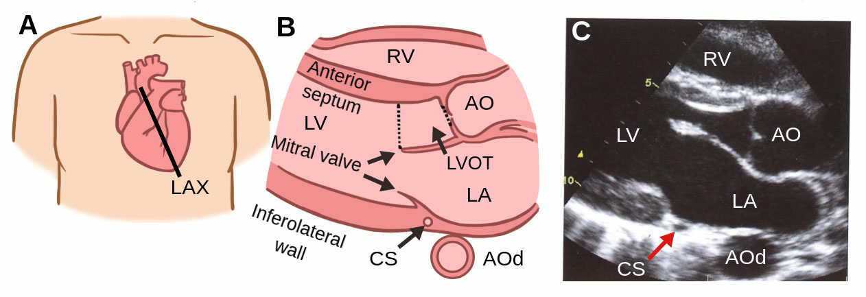 Transthoracic Echocardiogram With A Parasternal Long Axis Transthoracic Echocardiogram With A Parasternal Long Axis