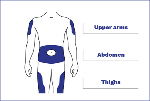 Insulin injection sites This image provides a visual guide for identifying the primary subcutaneous injection sites on the human body. These are areas where medicine can be safely injected into the fatty tissue layer just beneath the skin. The diagram features an outline of a human torso and limbs, with three specific regions highlighted in dark blue. The first one is upper arms. The highlights are located on the outer, posterior or back aspect of both the left and right upper arms, between the shoulder and the elbow. The second one is abdomen. A wide band is highlighted across the stomach area. It covers most of the abdominal region but specifically leaves a circular clear space around the navel, or belly button. The last one is thighs. The highlights are positioned on the front and outer sides of both the left and right thighs, extending from just below the hip to above the knee. Each of these highlighted areas is labeled with text to the right of the figure, using thin lines to point directly to the corresponding body part. These sites are chosen because they typically contain a sufficient layer of fat and are easily accessible for self-administration.