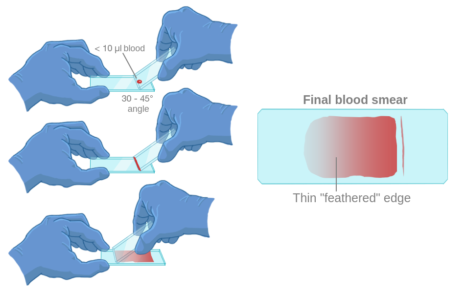 This image illustrates the step-by-step process for preparing a peripheral blood smear using the two-slide method. The process starts with a small drop of blood, labeled as less than 10 micro liters placed near one end of a clean glass slide, which is called the base slide The first diagram shows a gloved hand holding a second slide, called the spreader slide This spreader slide is brought into contact with the base slide, just in front of the blood drop. The spreader slide is held at an angle of 30 to 45 degrees relative to the base slide. In the second diagram, the spreader slide is pulled back until its edge touches the drop of blood The blood quickly spreads by capillary action along the entire width of the spreader's edge. In the third diagram, the spreader slide is then smoothly and rapidly pushed forward along the base slide. This motion drags the blood drop behind it, creating a uniform, thin film of blood.